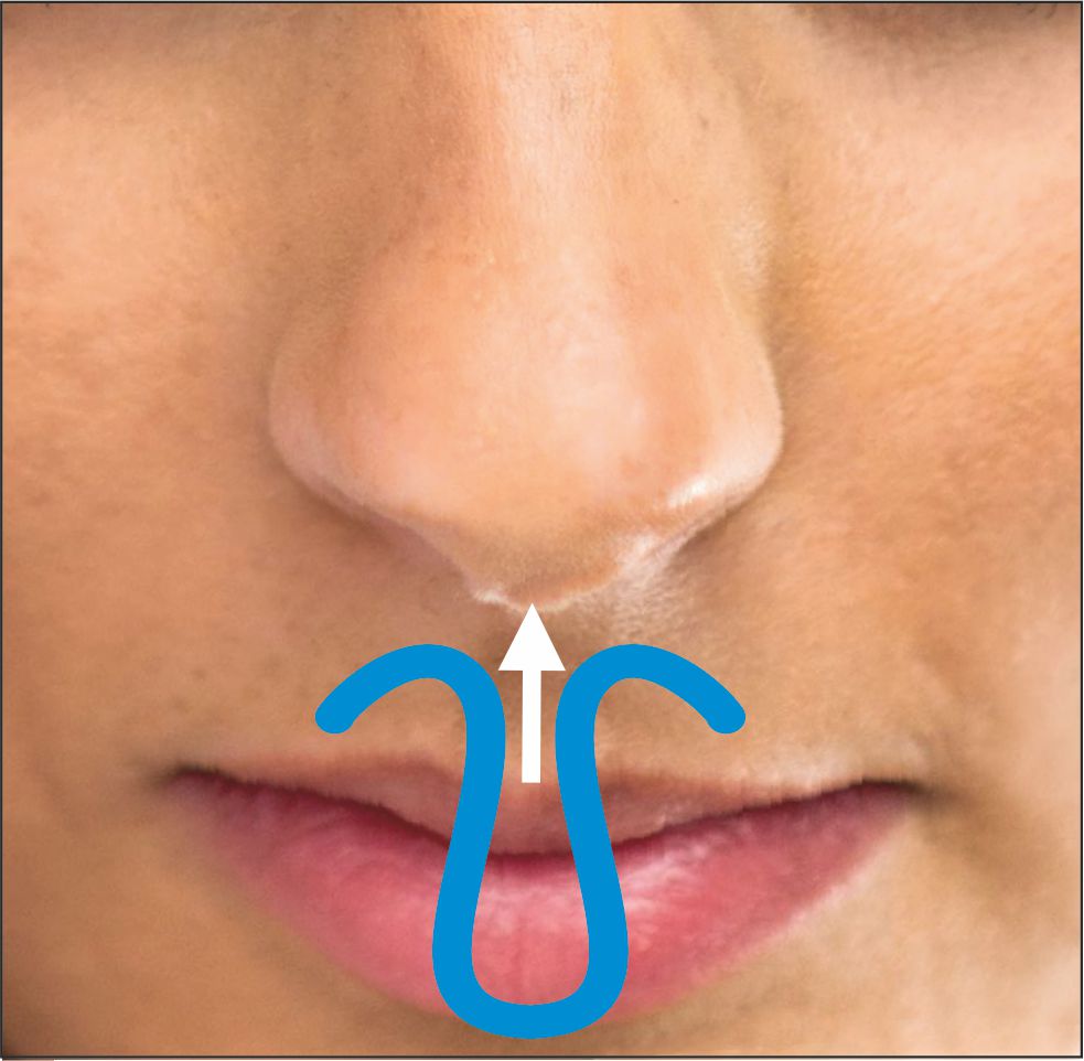 ClipAir Nasal spreader against snoring